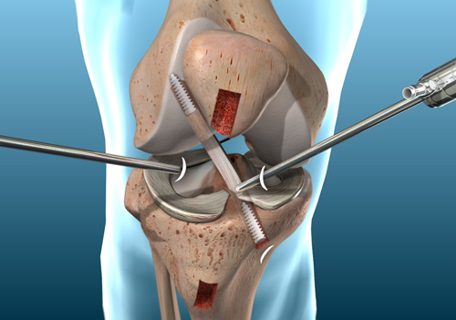 Best Doctor for ACL Reconstruction Surgery