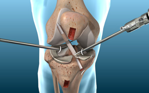 ACL Reconstruction Surgeon in Panchkula