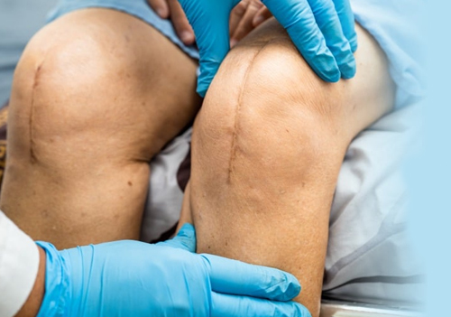 Best Doctor for Total Knee Replacement 