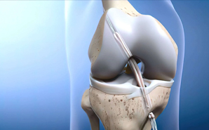 ACL Reconstruction Surgery in Mohali