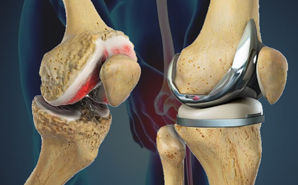 Best Total Knee Replacement Surgeon in Zirakpur