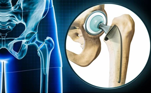 Best Total Hip Replacement Surgeon in Panchkula